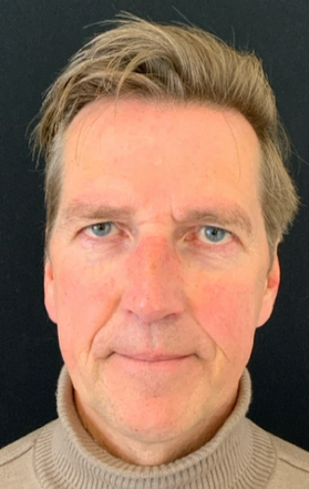 De deep plane voorhoofdslift – krachtige verj