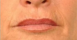 Mondveroudering: zo vermindert u rimpels en lijntjes rond de lippen - Prof. Aesthetics - Prof. Dr. Berend van der Lei