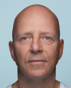 Radiesse filler: herstel volume & jeugdige uitstraling | Prof. Aesthetics