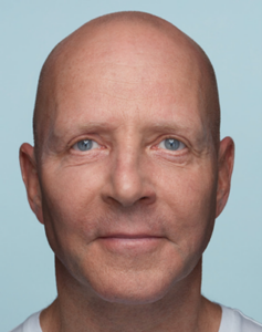 Radiesse filler: herstel volume & jeugdige uitstraling | Prof. Aesthetics