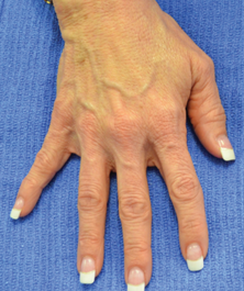 Radiesse filler: herstel volume & jeugdige uitstraling | Prof. Aesthetics