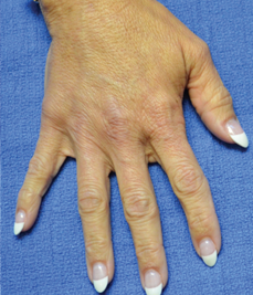 Radiesse filler: herstel volume & jeugdige uitstraling | Prof. Aesthetics