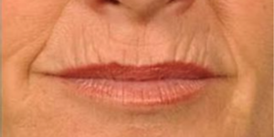 Mondveroudering: zo vermindert u rimpels en lijntjes rond de lippen - Prof. Aesthetics - Prof. Dr. Berend van der Lei