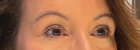 Wallen en zware oogleden aanpakken met een oo