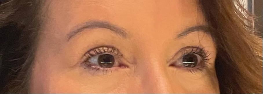 Bovenooglidcorrectie: redenen, mogelijkheden 