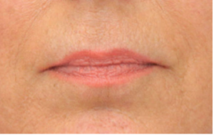 Mondhoeklift zonder operatie: de niet-chirurgische methode voor een jeugdige uitstraling - Prof. Aesthetics - Prof. Dr. Berend van der Lei