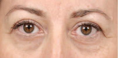 Onderooglidcorrectie: de behandeling tegen wallen - Prof. Aesthetics - Prof. Dr. Berend van der Lei