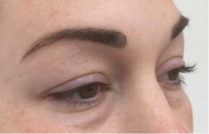 Veelgestelde vragen over een onderooglidcorre