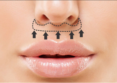 Lipvergroting: meer volume en natuurlijk vollere lippen - Prof. Aesthetics - Prof. Dr. Berend van der Lei