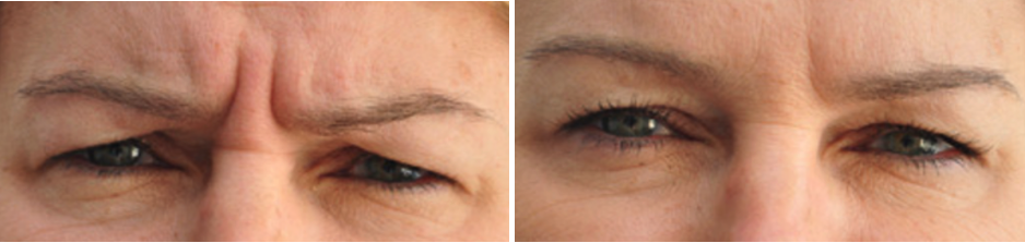 Fronsrimpel botoxbehandeling