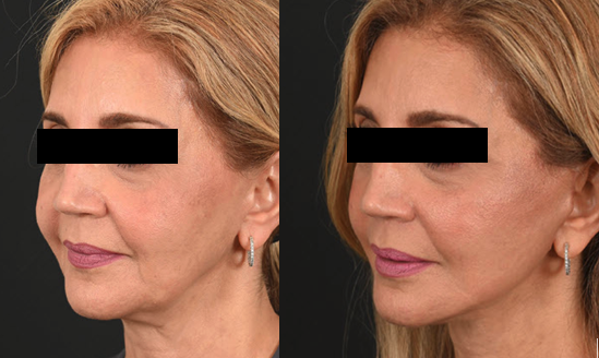 Facelift met natuurlijk resultaat: weer fris 