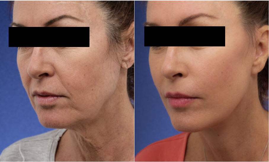 Deep Plane Facelift: alles over de meest natuurlijke facelift - Prof. Aesthetics - Prof. Dr. Berend van der Lei