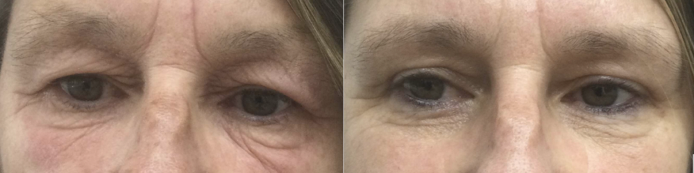 Vragen over een bovenooglidcorrectie - Prof. Aesthetics - Prof. Dr. Berend van der Lei