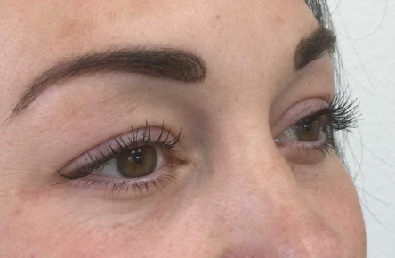 Onderooglidcorrectie: de beste oplossing voor wallen onder de ogen - Prof. Aesthetics - Prof. Dr. Berend van der Lei