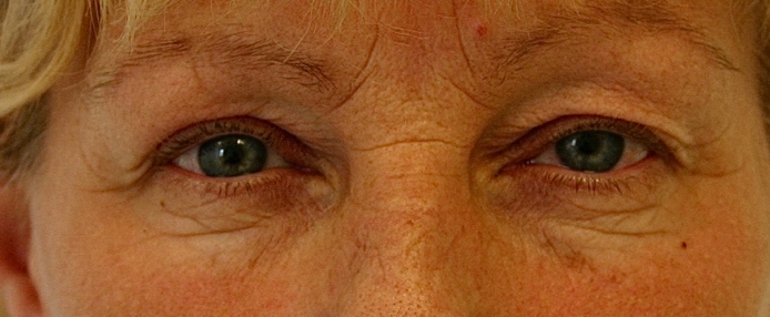 De bovenooglidcorrectie: klein van formaat, groot in effect