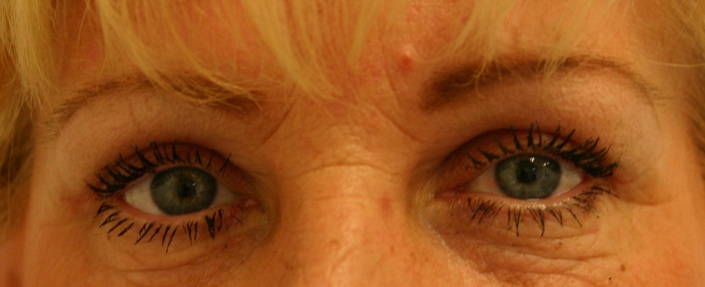 Bovenooglidcorrectie na – 51-jarige vrouw