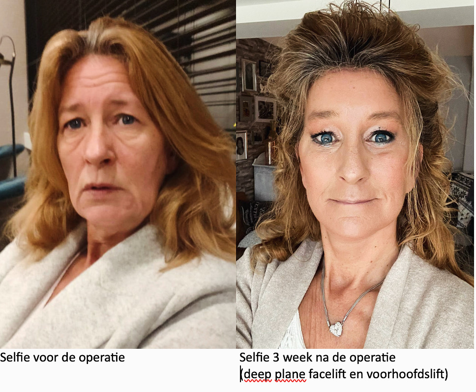 Deep plane facelift: er op natuurlijke wijze jaren jonger uitzien - Prof. Aesthetics - Prof. Dr. Berend van der Lei