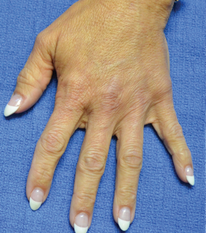 Handverjonging met fillers: herstel van volume en jeugdige uitstraling - Prof. Aesthetics - Prof. Dr. Berend van der Lei