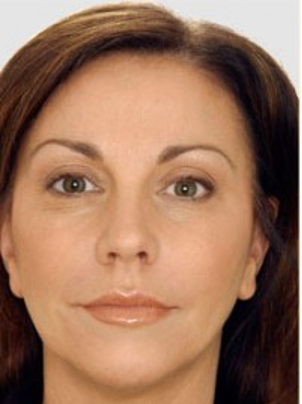 Liquid Facelift uitgelegd: natuurlijke verjonging zonder operatie? - Prof. Aesthetics - Prof. Dr. Berend van der Lei