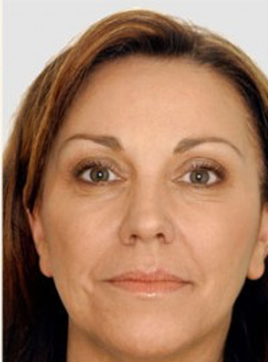 Liquid Facelift uitgelegd: natuurlijke verjon