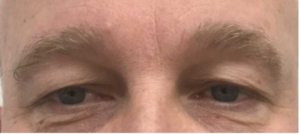 Ooglidcorrectie bij mannen: zo bereik je een 