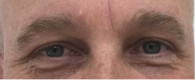 Bovenooglidcorrectie uitgelegd: huidoverschot