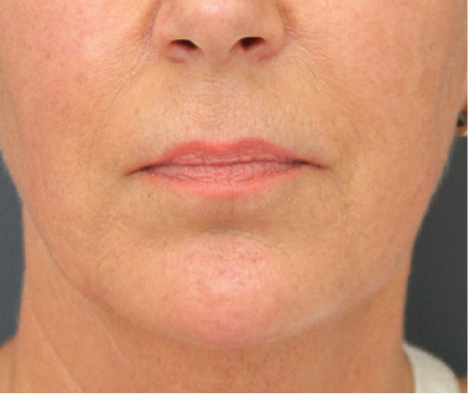 Mondhoeklift: de oplossing voor hangende mondhoeken - Prof. Aesthetics - Prof. Dr. Berend van der Lei