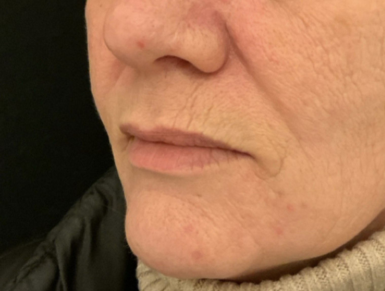 De mondhoeklift: effectieve oplossingen voor hangende mondhoeken