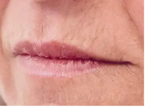 Rimpels boven de lip behandelen: de oplossing voor rokerslijntjes - Prof. Aesthetics - Prof. Dr. Berend van der Lei