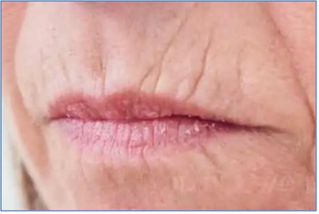 Rimpels boven de lip behandelen: de oplossing