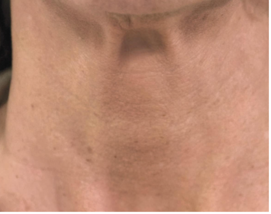 Soorten fillers en hun werking: hyaluronzuur, Profhilo en Radiesse - Prof. Aesthetics - Prof. Dr. Berend van der Lei