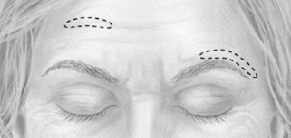 Wat kun je doen aan de laagstand van wenkbrauwen? - Prof. Aesthetics - Prof. Dr. Berend van der Lei